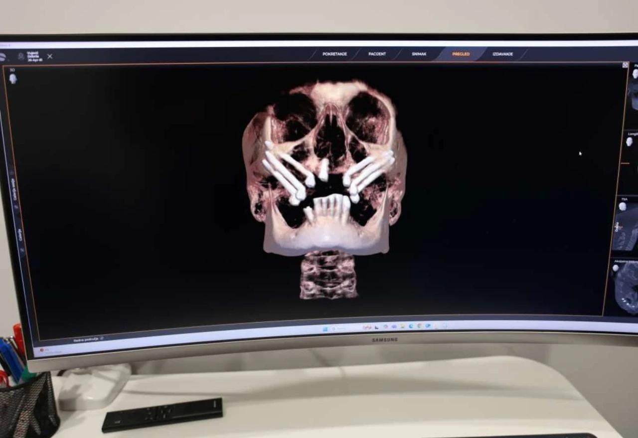 Mostarski i sarajevski kirurzi prvi u regiji izveli zahvat Triple Zygoma